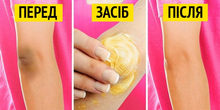 3 ефективні засоби для освітлення темних ліктів 44 2 9 1